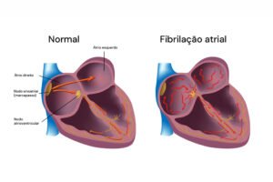 Fibrilação Atrial