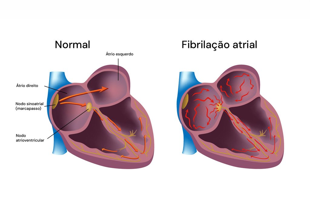 Fibrilação Atrial: Diagnóstico, Tratamento e Complicações